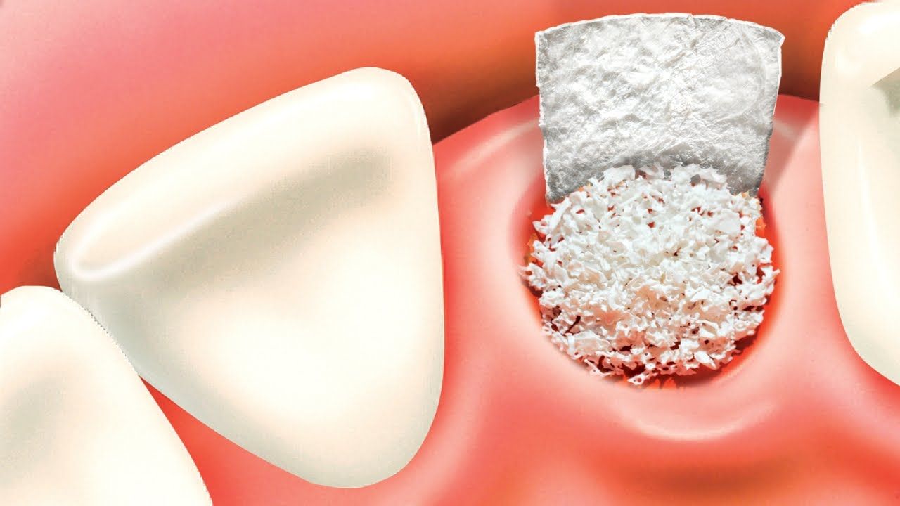 Bone Grafting » Tottenham Dentist | Queen Street Dental