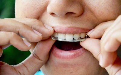 Care Following Orthodontics – Retainers