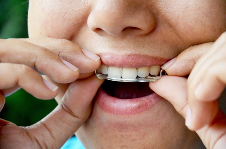 retainers