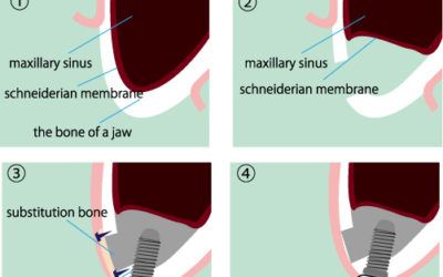 Ridge and Sinus Augmentations