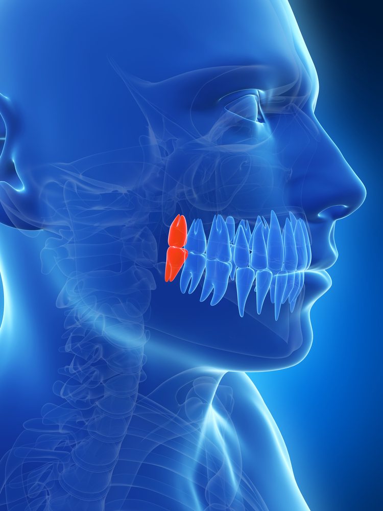wisdom-teeth-removal
